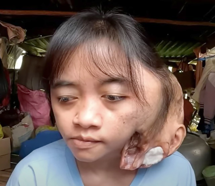 xinh-6-6-3265-1685116997 Pi Năng Thị Xinh đã sống với khối u chiếm phân nửa khuôn mặt gần 20 năm. Ảnh: Cắt từ clip Gà lang thang