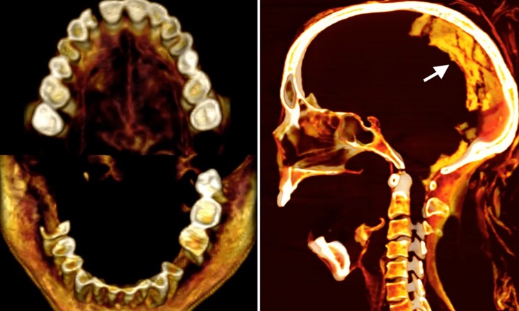 vne-mum-7973-1722701444 Ảnh chụp cắt cắt lớp khuôn miệng há to của Người phụ nữ hét. Ảnh: Sahar Saleem