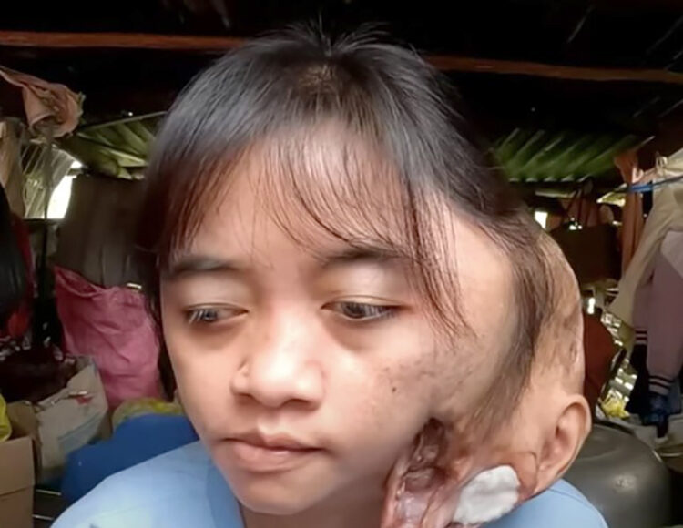 Pi Năng Thị Xinh đã sống với khối u chiếm phân nửa khuôn mặt gần 20 năm. Ảnh: Cắt từ clip Gà lang thang