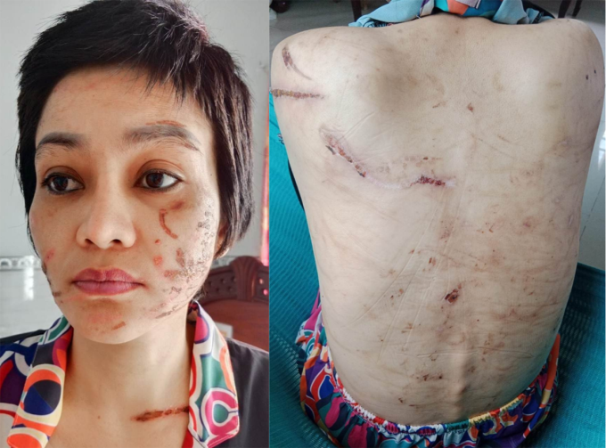 Chị Giao chi chít vết thương trên người. Ảnh: Gia đình cung cấp