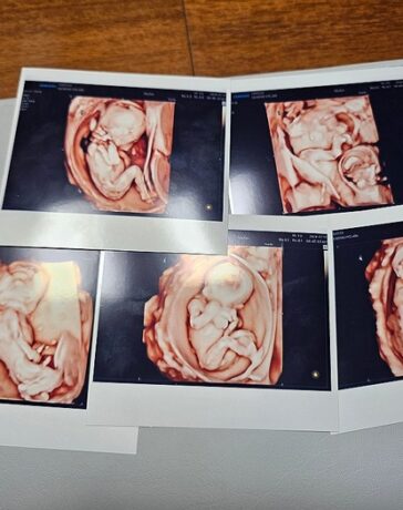 Siêu âm 5 con đầu lòng của vợ chồng Kim và Sagong. Ảnh: Yonhap
