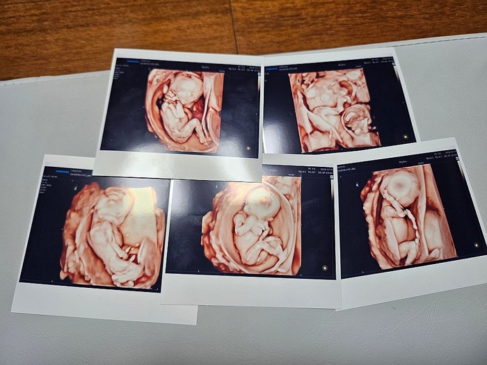 Siêu âm 5 con đầu lòng của vợ chồng Kim và Sagong. Ảnh: Yonhap